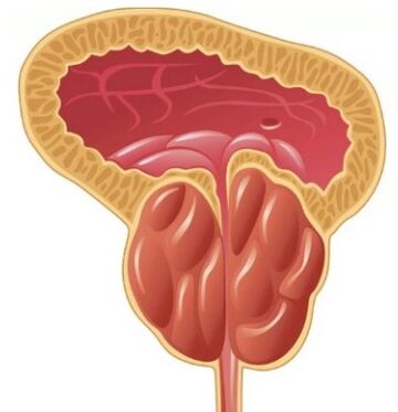 Prostatitis