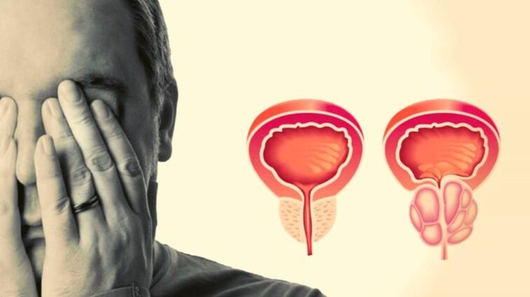 A man with prostatitis