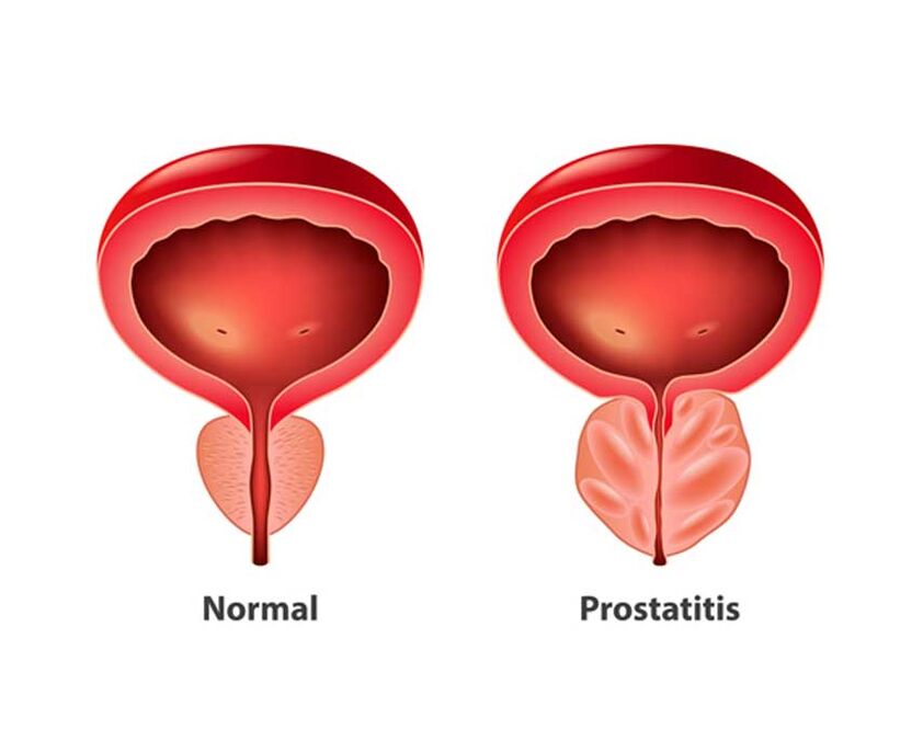 Normal prostate and inflammation