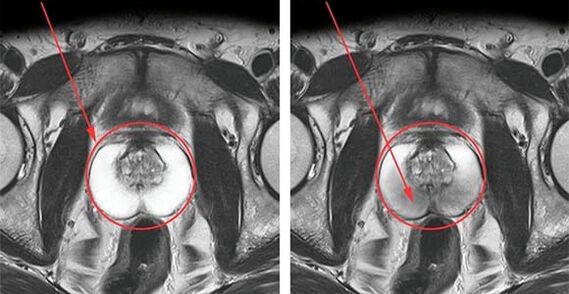 Normal prostate (left) and prostatitis with prostatitis (right)
